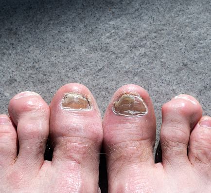 ugly toe pics